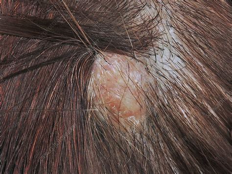 Epidermoid Cyst Scalp