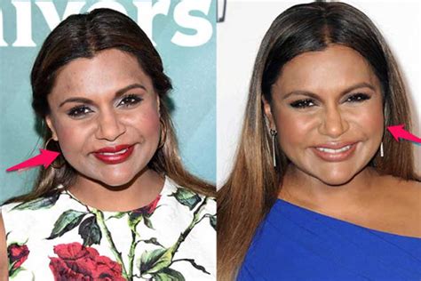 Mindy Caling Before And After Plastic Surgerysmileage