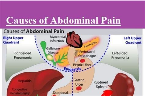 Causes Of Abdominal Pain Mnemonic Medical Estudy