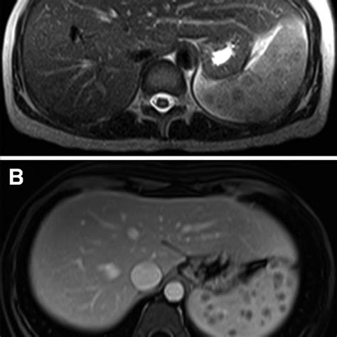 Pdf Splenic Sarcoidosis A Case Report And Review Of The Imaging