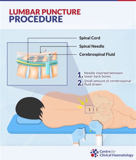 Lumbar Puncture Cfch Centre For Clinical Haematology