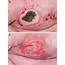 Cachexia And Skin Lesions In An Acutely Unwell Man  Manupati Et Al