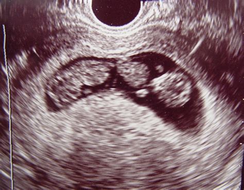 1st Trimester Ultrasound Scanning