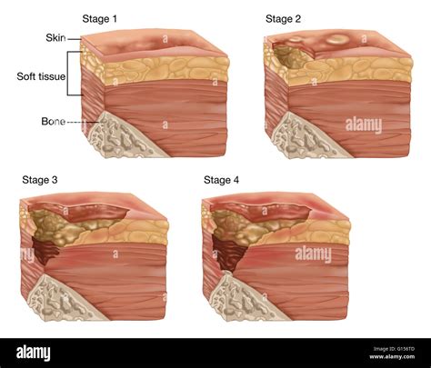 Illustration Showing The 4 Stages Of A Bedsore Or Pressure Sore Stock