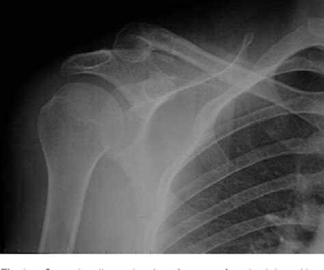 Treatment Of Neer Type 2 Fractures Of The Distal Clavicle With