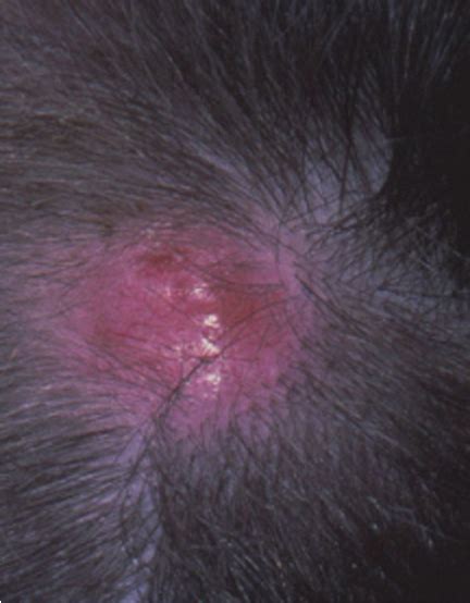 Skin Cancer Lesions On Scalp