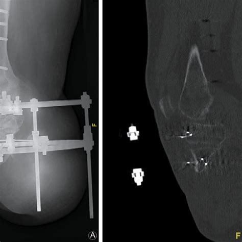 Pdf Lengthening Of A Below Knee Amputation Stump With Ilizarov