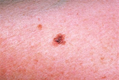 Malignant Melanoma Blemish On The Skin Photograph By Dr P Marazzi My
