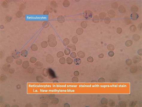 Reticulocyte Count Introduction Determination Normal Range And Clinic