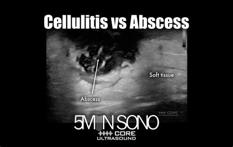 Cellulitis Vs Abscess Ultrasound Sexiz Pix