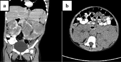 A And B Cect Abdomen Depicting Bilateral Renal Masses Download
