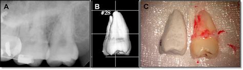 Orthognathic Treatment With Autotransplantation Of A Third Molar