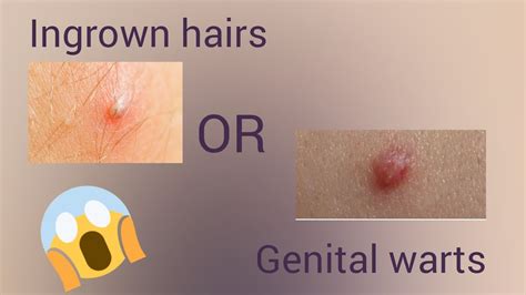 Genital Warts Or Ingrown Hairare Those Really Ingrown Hairs Genital