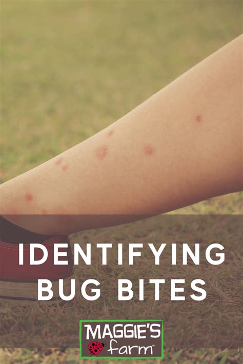 Identifying Bug Bites Identifying Bug Bites Bug Bites Bug Bite On Face