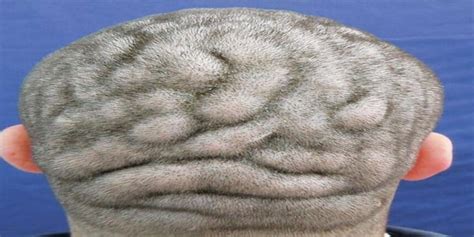 This Man Suffers From Rare Condition That Makes His Scalp Look Like The