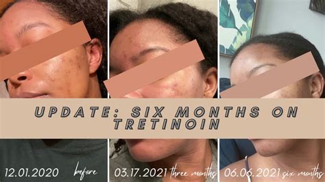 Six Months On Tretinoin Is My Skin Clear Acne And Post Inflammatory