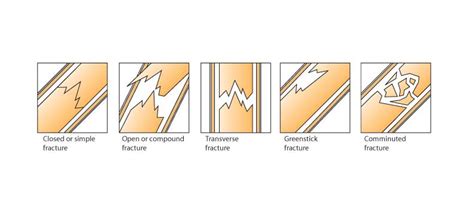 Check spelling or type a new query. Treating a Broken Bone - Nate C. and Tyler B. and Dani H ...