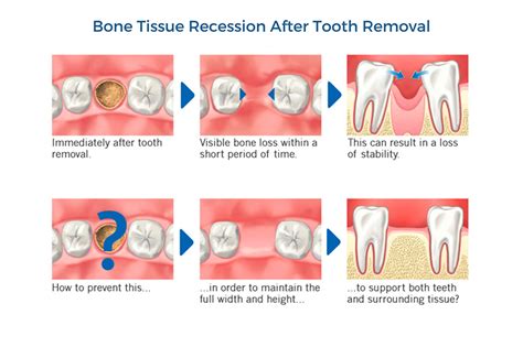 Dentist Answers Top 12 Dental Bone Grafting Questions Blyss Dental