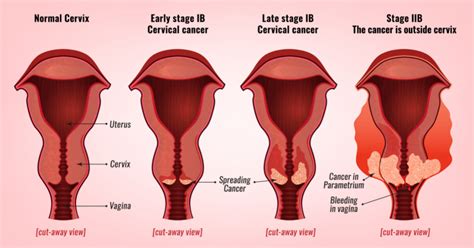 Cervical Cancer Stages Prof Andreas Obermair Professor Andreas Obermair