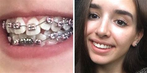 114 Incredible Before And After Transformations Of People Who Wore Braces Teeth After Braces