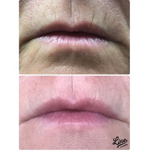 Learn What Type Of Lip Fillers Are Best For You Laser Lipo And Veins