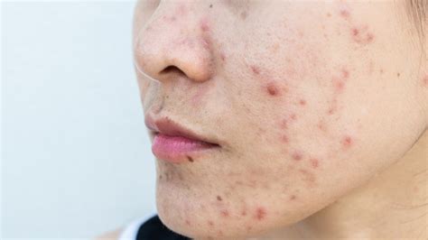 Hautkrankheiten Mit Bildern Erkennen