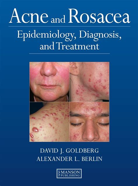 Acne And Rosacea Epidemiology Diagnosis And Treatment Goldberg