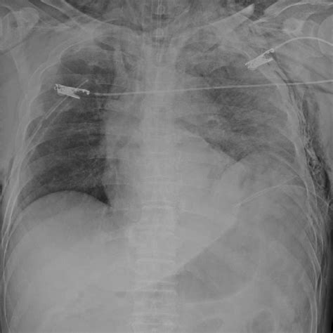 Chest Anteroposterior View Radiograph Shows Elevated Left Diaphragm And