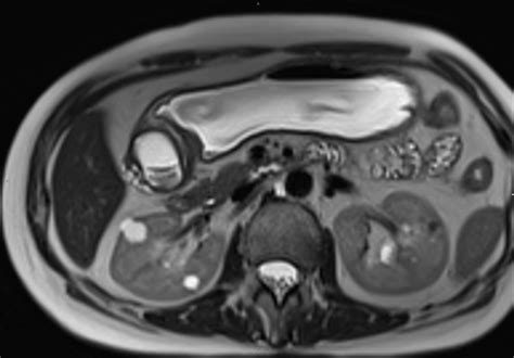 Pancreatic Heterotopia Ecr 2014 Case Of The Day Eurorad