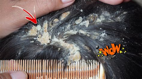 Dandruff Scratching Itchy Dry Scalps Psoriasis Huge Flakes Removal