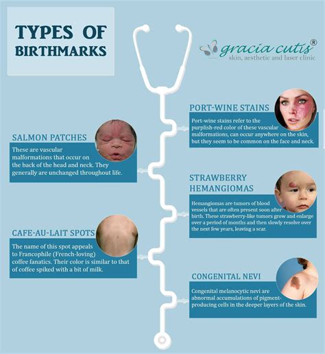 Types Of Birthmarks Birthmark Laser Clinics Port Wine Stain