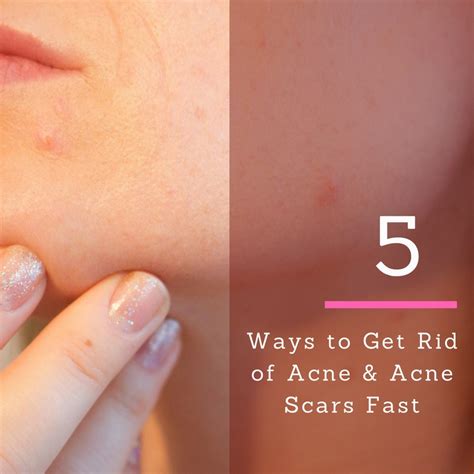 5 Ways To Get Rid Of Acne And Acne Scars Fast — Bump And Beyond