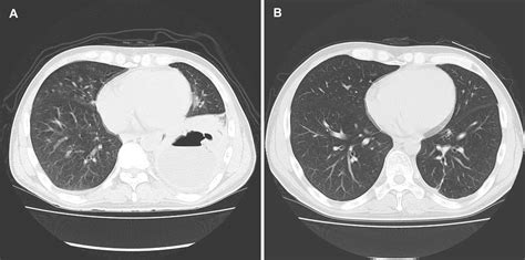 Three Cases With A Lung Abscess And Bronchial Inflammatory Polyps