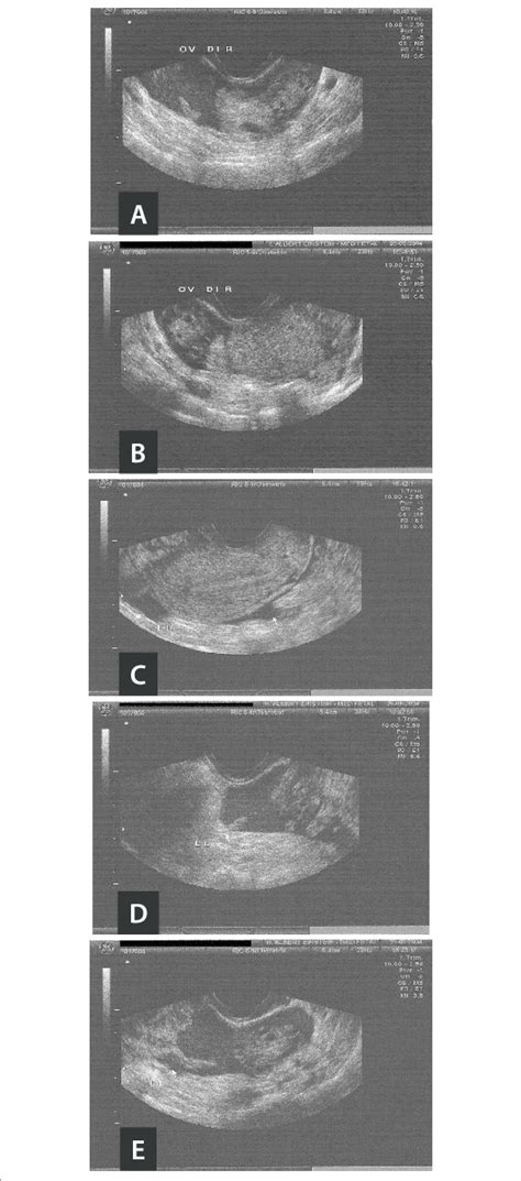 Transvaginal Ultrasound On The Ectopic Pregnancy Left A And B Right