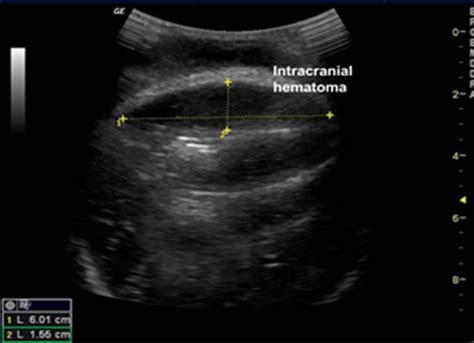 Subgaleal Hemorrhage Ultrasound