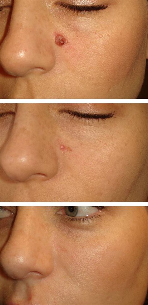 Granuloma Removal Laser Before And Afters Áda Aesthetic Medicine