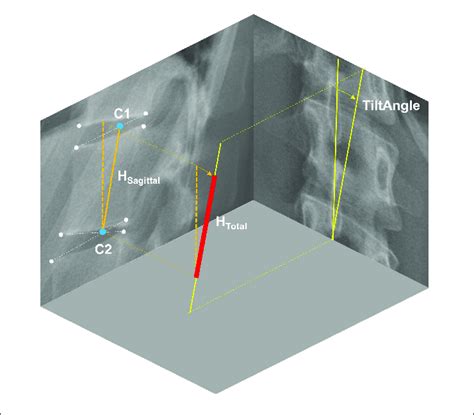 Determination Of Vertebral Body Height H Total From Radiographic