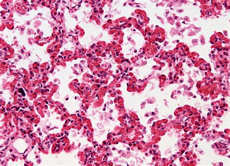 Viral Pneumonia At 20x Magnification Nikons Microscopyu