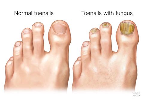 Fungal Toenail Treatment Council Bluffs Foot And Ankle Care Pc