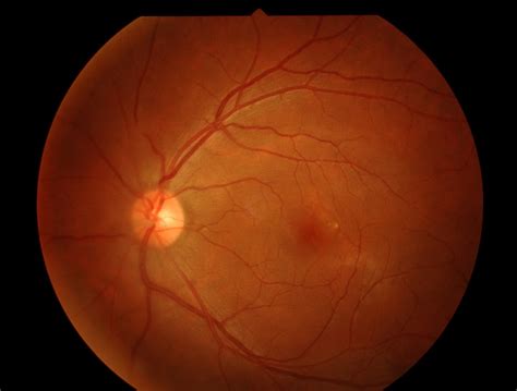 Digital Retina Imaging Ganly Vision Care