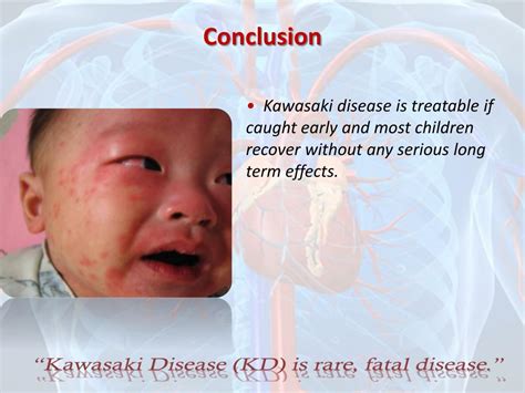 Ppt What Is Kawasaki Disease Powerpoint Presentation Free Download
