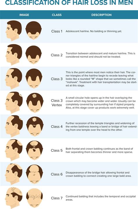 30 Types Of Male Hair Loss