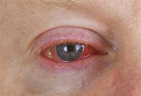 Conjunctivitis Is Spreading Across The Country Heres What You Need To