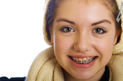5 Things You Need To Know About Getting Braces