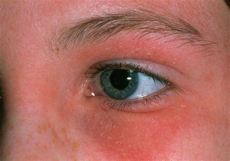 Eczema Around Eye Photograph By Dr P Marazzi Science Photo Library My