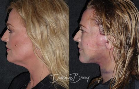 Nadine 45 45 54 Face And Necklift Jowls Liposculpture Neck Dr Dominic Bray