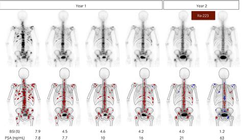 Bone Scan Index A New Biomarker Of Bone Metastasis In Patients With