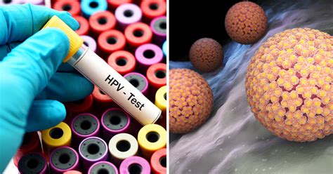 It is a very common virus. HPV Treatment: Causes, Symptoms & 4 Natural Treatments ...