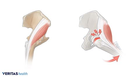 3 Types Of Snapping Hip Syndrome