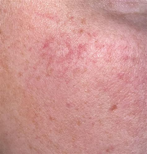 Skin Rashes Anyone Get Similar Ones Some Looks Almost Circular Its